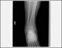骨折または骨折疑い