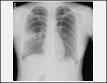 肺炎または肺炎疑い