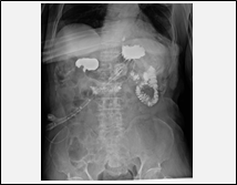 胃ろう交換の手技確認